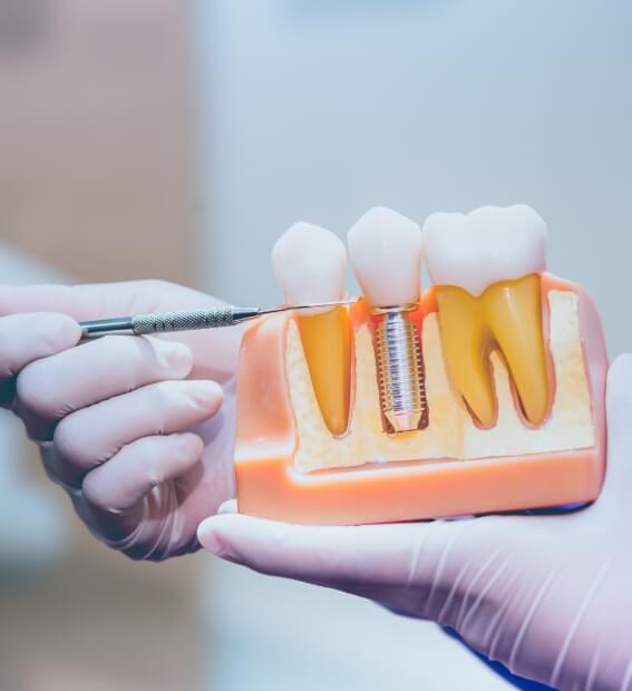 Dentist pointing at smile model showing dental implant supported replacement tooth