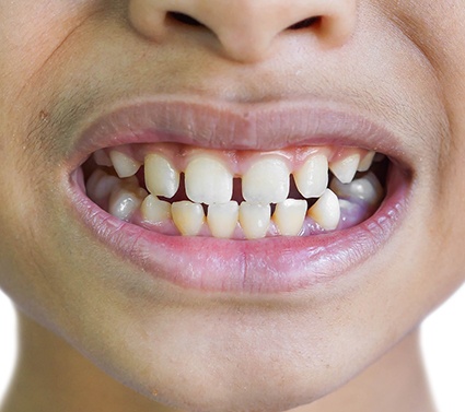 gaps between teeth that need Invisalign in Plano