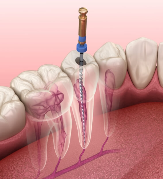 Animated smile during root canal therapy process